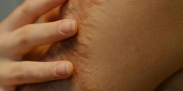 La gestione avanzata delle cicatrici: la sinergia clinica tra Tecar e QMR